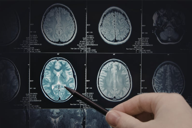 atrophy brain