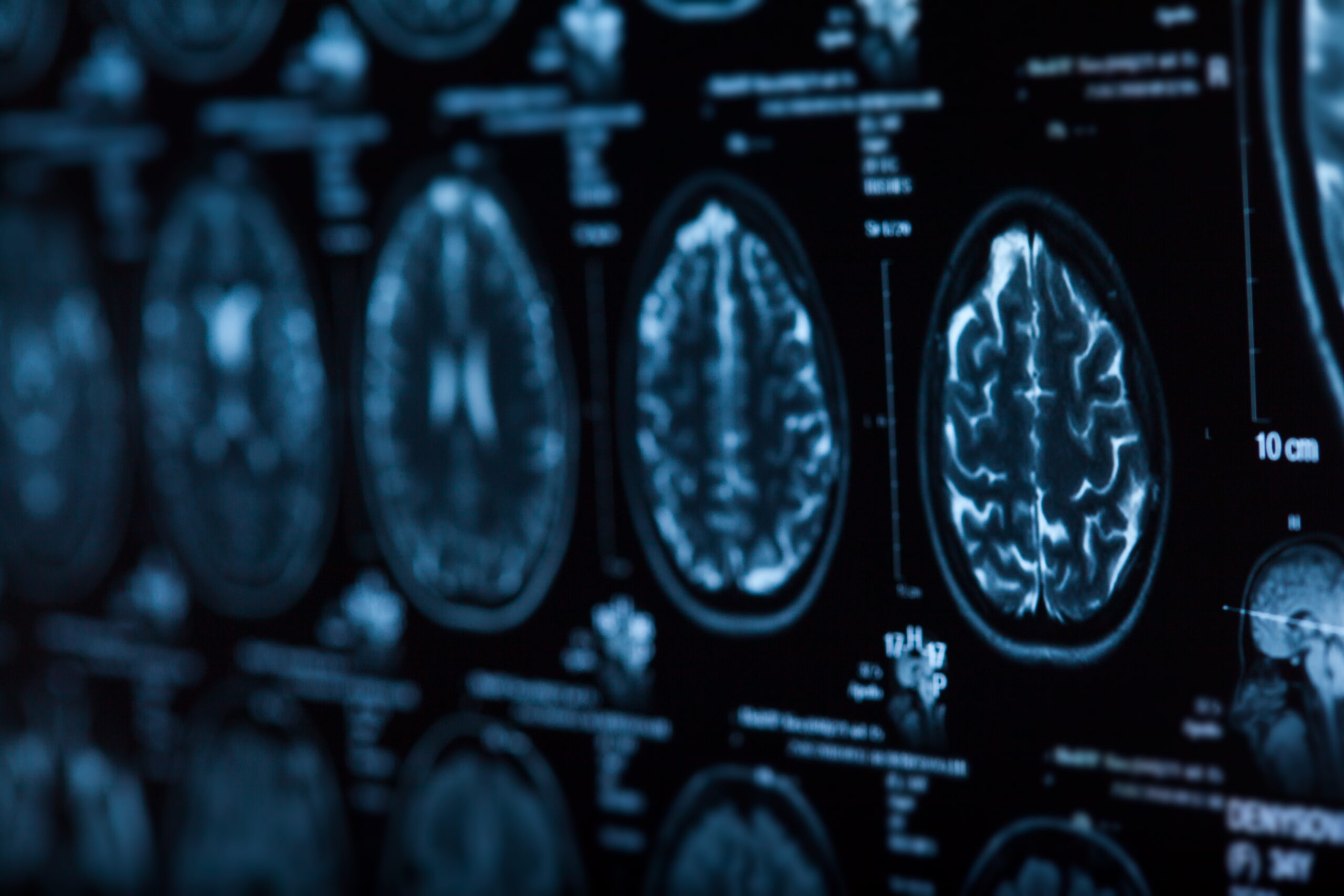 brain IRM ; biomarkers