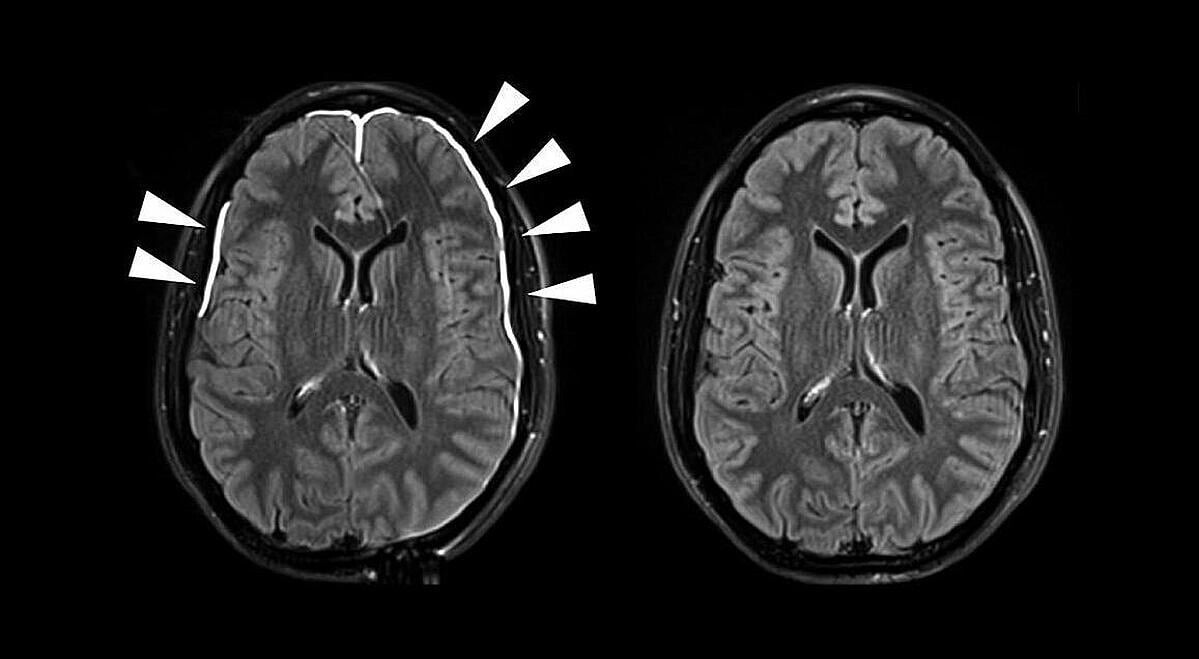 Brain, biomarkers 