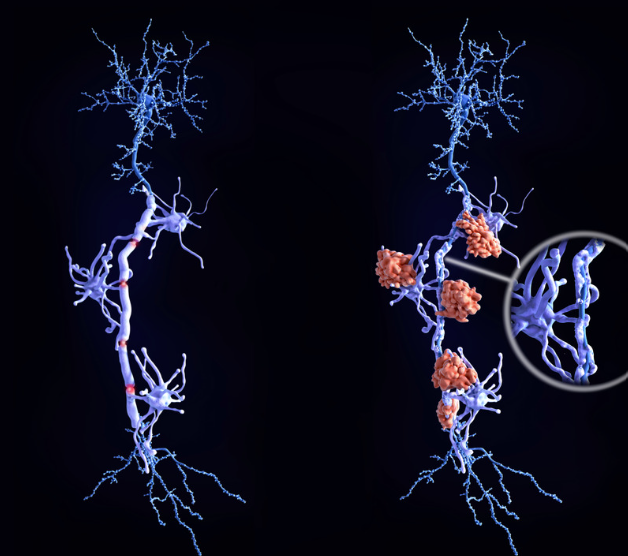 multiple sclerosis 
